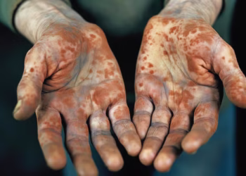 Romania Reports First Leprosy Cases in Over Four Decades, Involving Indonesian Nationals