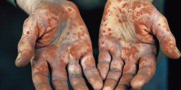Romania Reports First Leprosy Cases in Over Four Decades, Involving Indonesian Nationals