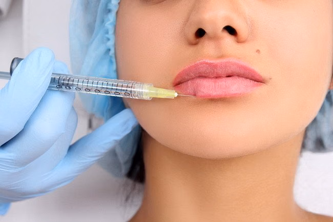 Beauty, Risk, and the Pursuit of Perfection: What the Death of an Estée Lauder Executive Reveals About Cosmetic Fillers 40 Illustration of filler injections.