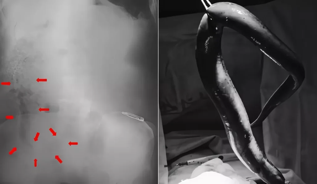 A live 65-centimeter (cm) eel was lodged inside a Bangladeshi man's intestine. (Photo: International Journal of Surgery Case Reports)