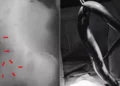 A live 65-centimeter (cm) eel was lodged inside a Bangladeshi man's intestine. (Photo: International Journal of Surgery Case Reports)
