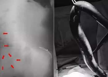 A live 65-centimeter (cm) eel was lodged inside a Bangladeshi man's intestine. (Photo: International Journal of Surgery Case Reports)