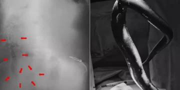 A live 65-centimeter (cm) eel was lodged inside a Bangladeshi man's intestine. (Photo: International Journal of Surgery Case Reports)