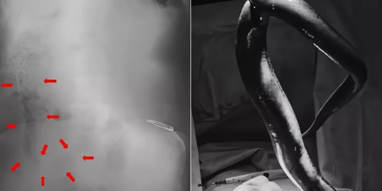 A live 65-centimeter (cm) eel was lodged inside a Bangladeshi man's intestine. (Photo: International Journal of Surgery Case Reports)